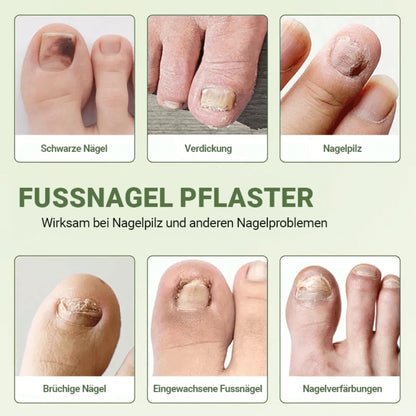 Fussnagel Patches
